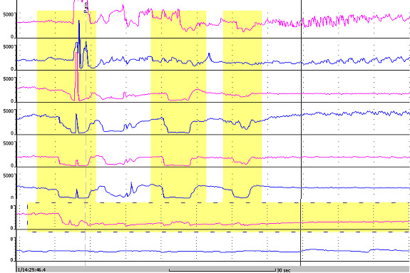 Superimposed acidic reflux